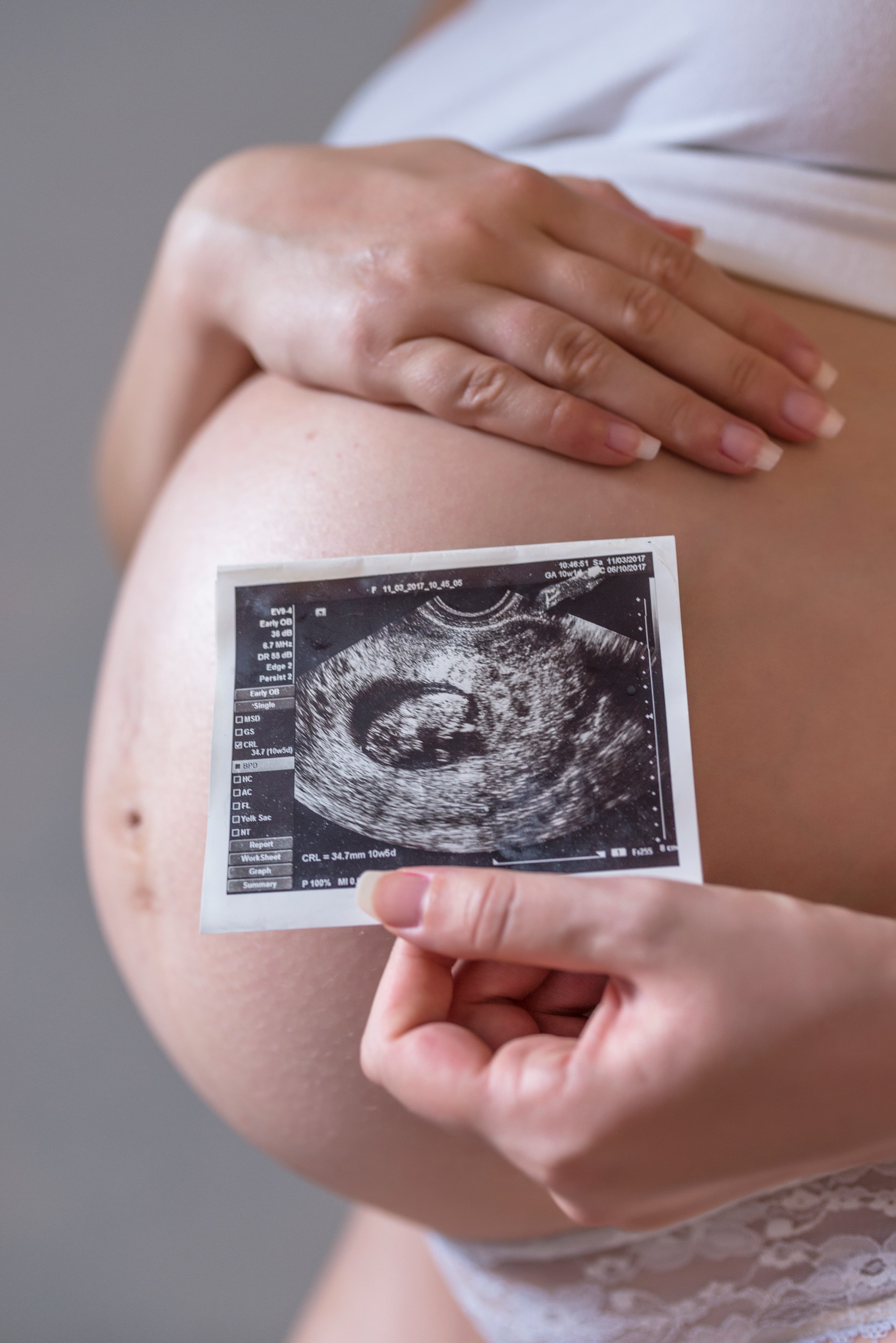 Ecografía prenatal
